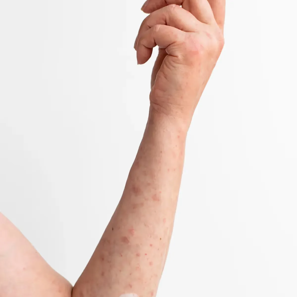 Featured image: How to Remove Deep Chicken Pox Scars?
