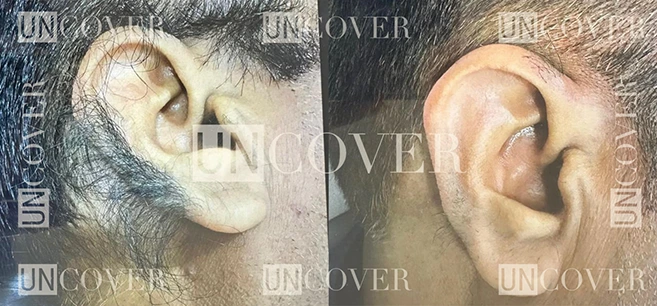 Featured image: How to remove ear hair permanently - Easy and Safe methods 