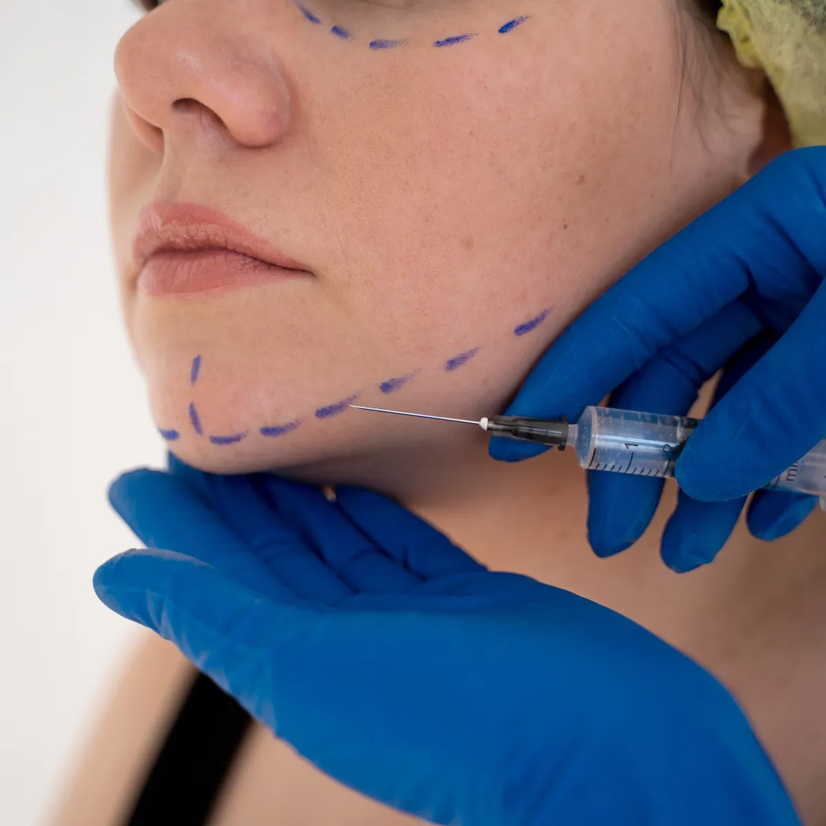 Featured image: How to remove old scars: Treatment, procedure and cost