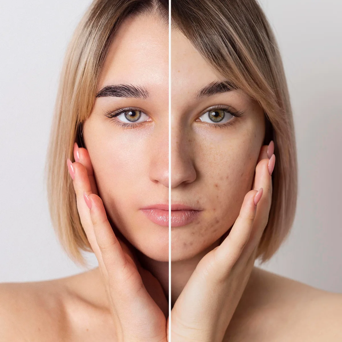 Featured image: Hyperpigmentation vs melasma: Types and treatment