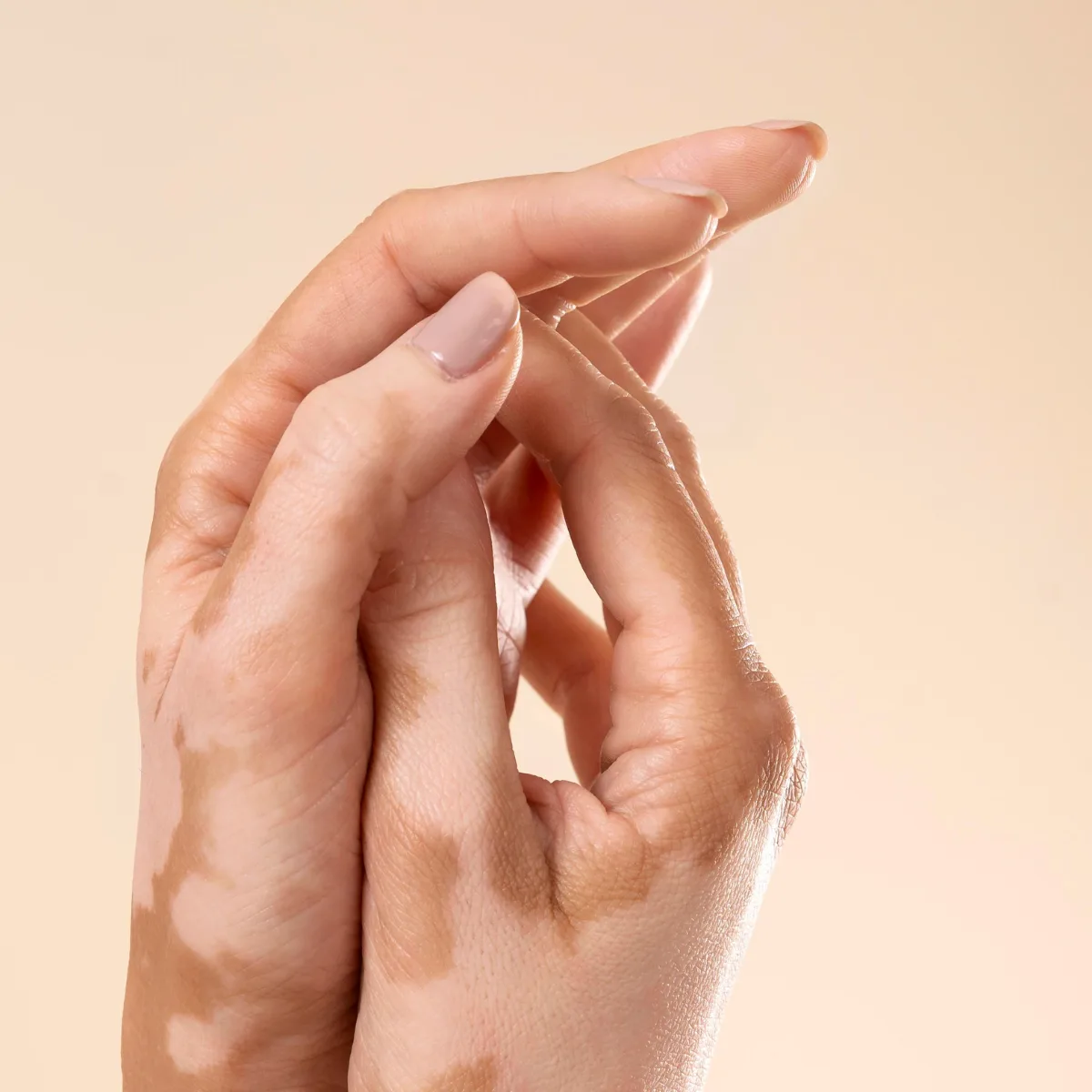 Featured image: I have vitiligo. Which treatment is the best?