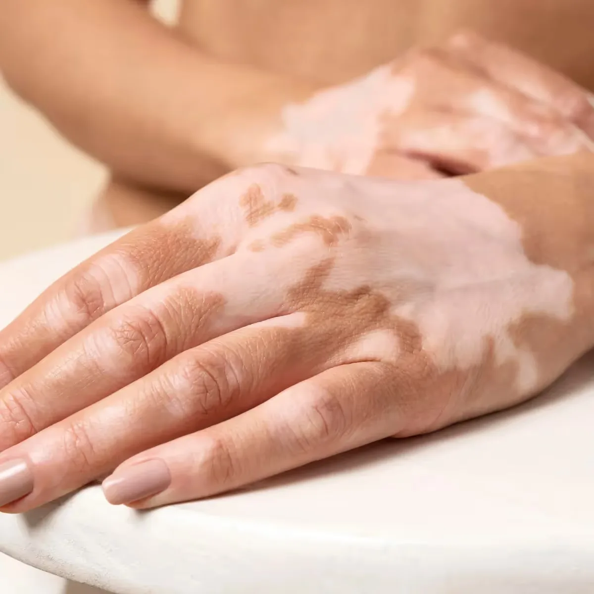 Featured image:  Is Micropigmentation Safe for Vitiligo? A Human Take