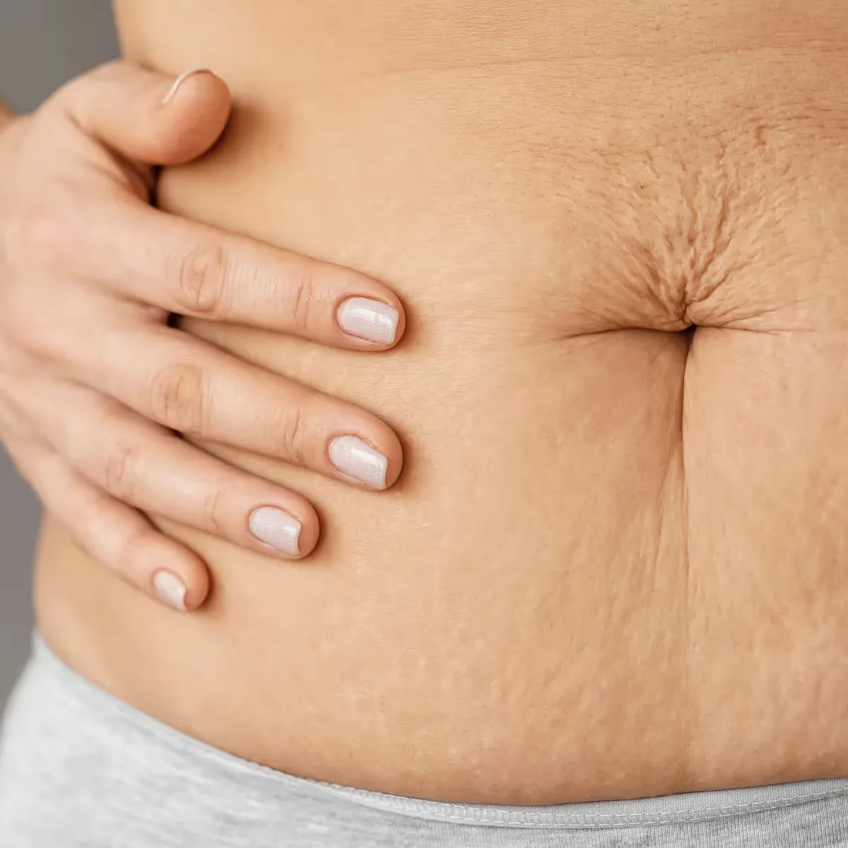 Featured image: Natural Home Remedies for Stretch Marks