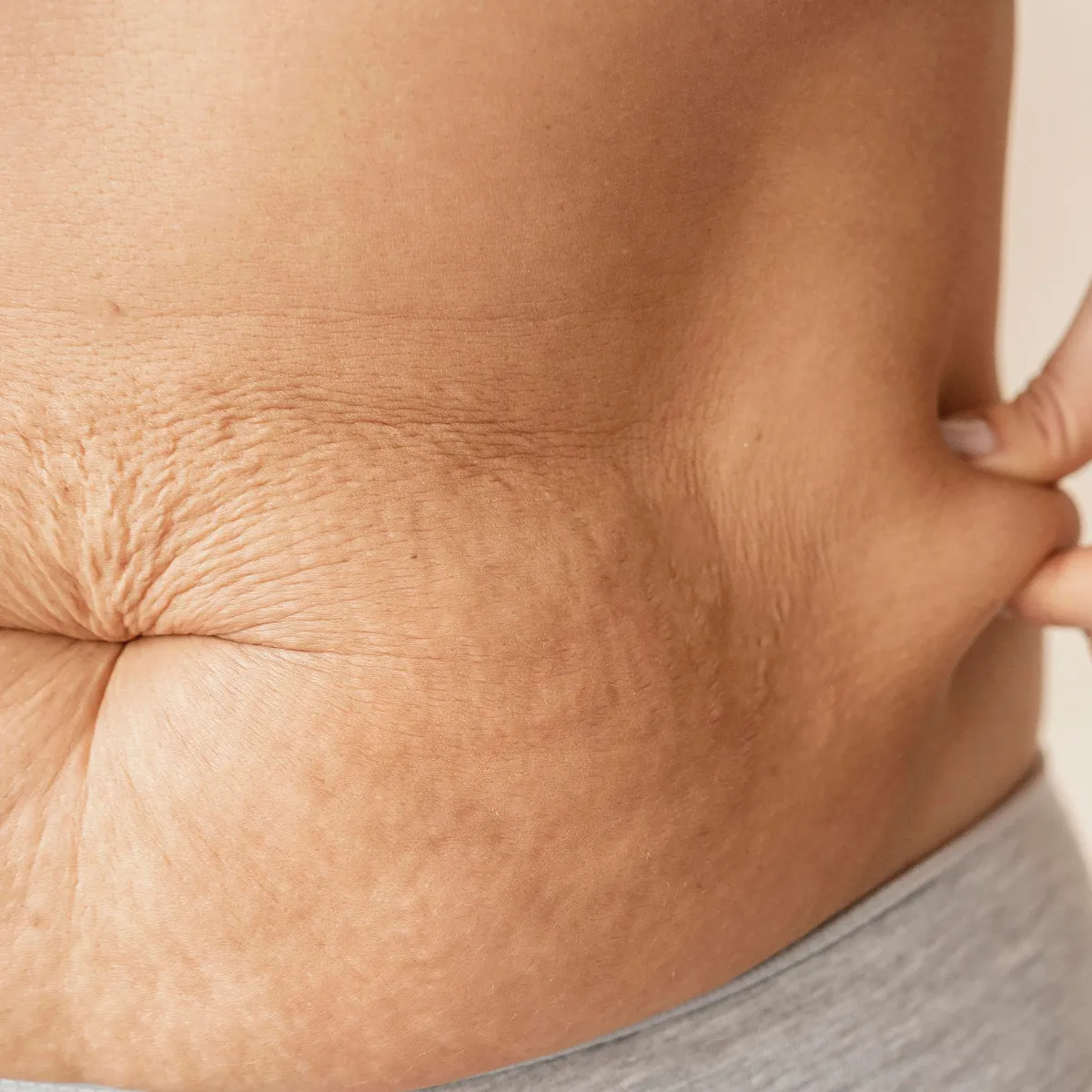 Featured image: Pregnancy and Stretch Marks: Understanding and Coping With Changes in the Skin