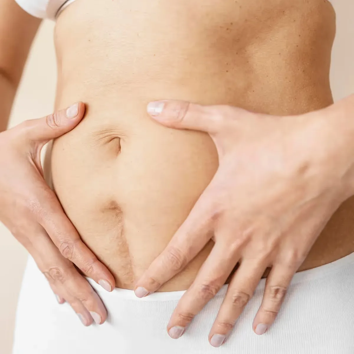 Featured image: Stretch Marks Cream After Delivery: The Gentle Care Your Skin Deserves