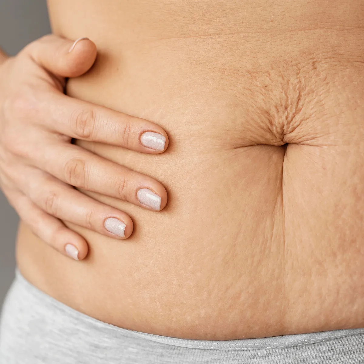 Featured image: Stretch marks: How to Get Rid of Them?