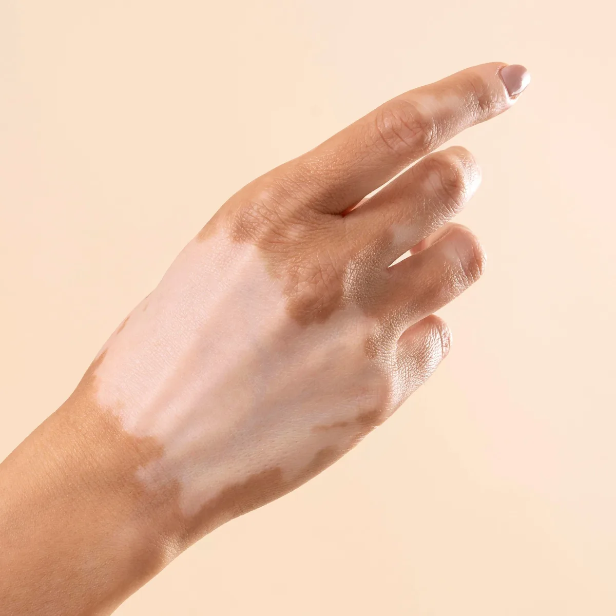 Featured image: Vitiligo pigmentation cream