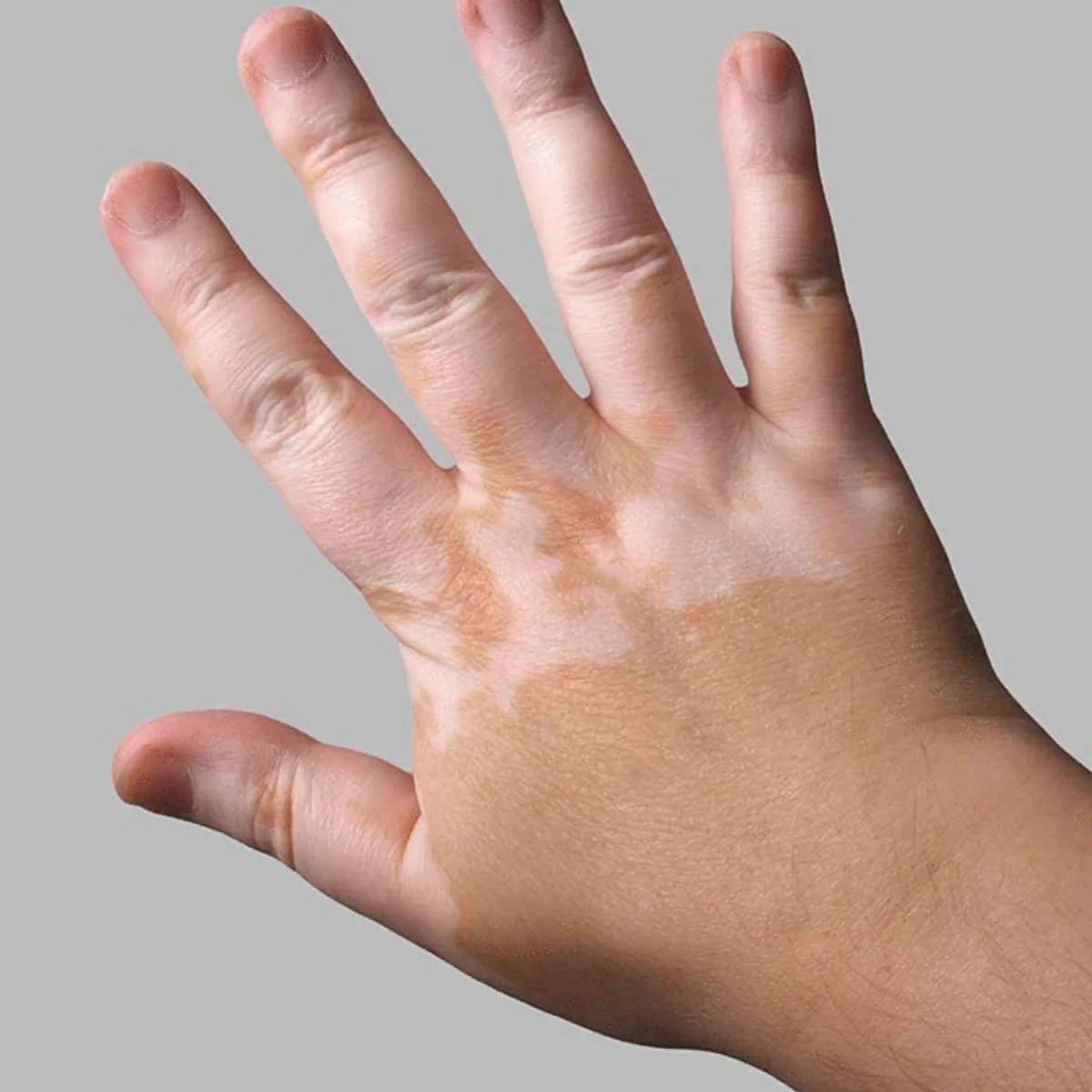 Featured image: Vitiligo: Symptoms, Causes, and Treatment/Vitiligo Skin Pigmentation
