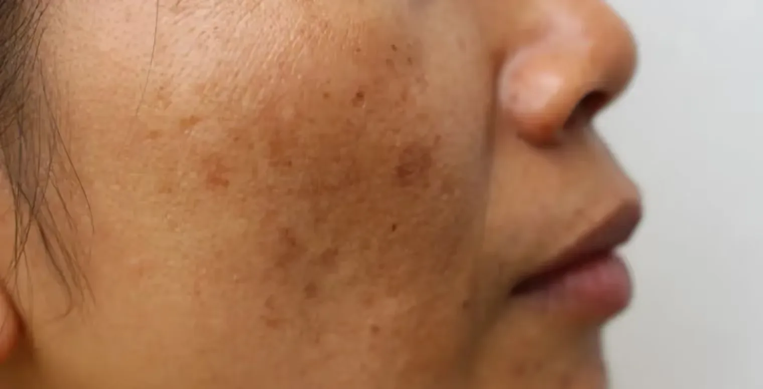 Header image: Skin Dullness 