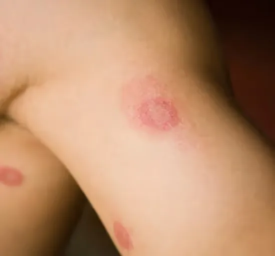 Header image: Skin Infections