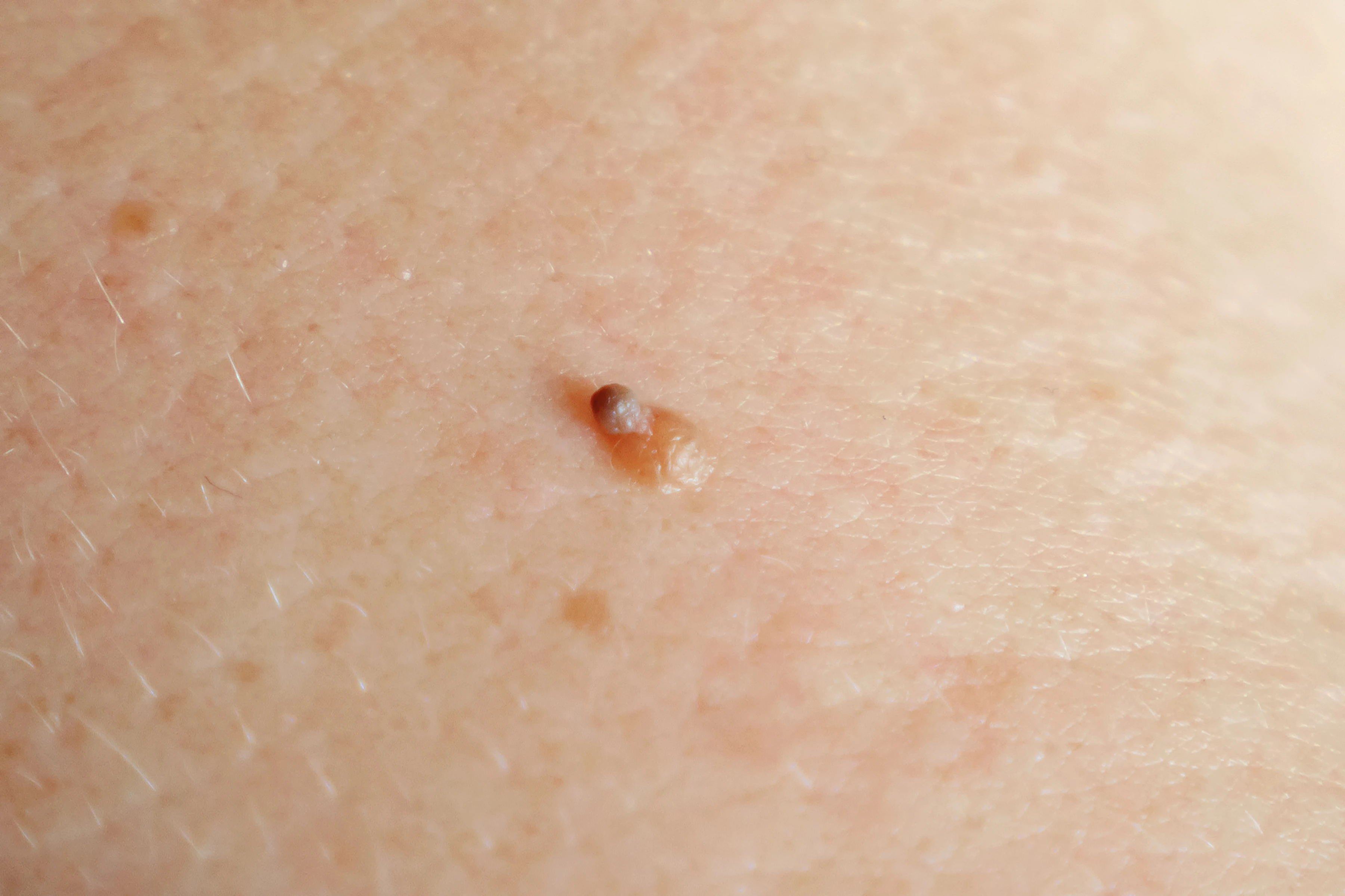 Header image: Skin Tags 