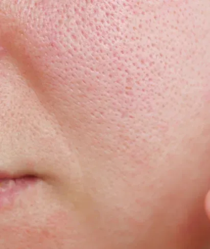 open pores