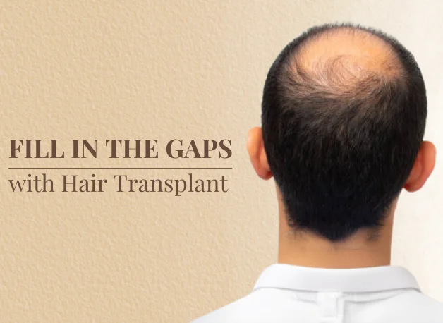 Advanced Hair Transplant Procedure
